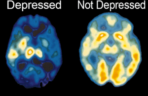 Brain Scan comparing depressed vs not depressed